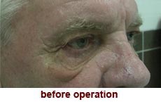 plastic-surgery-blepharoplasty